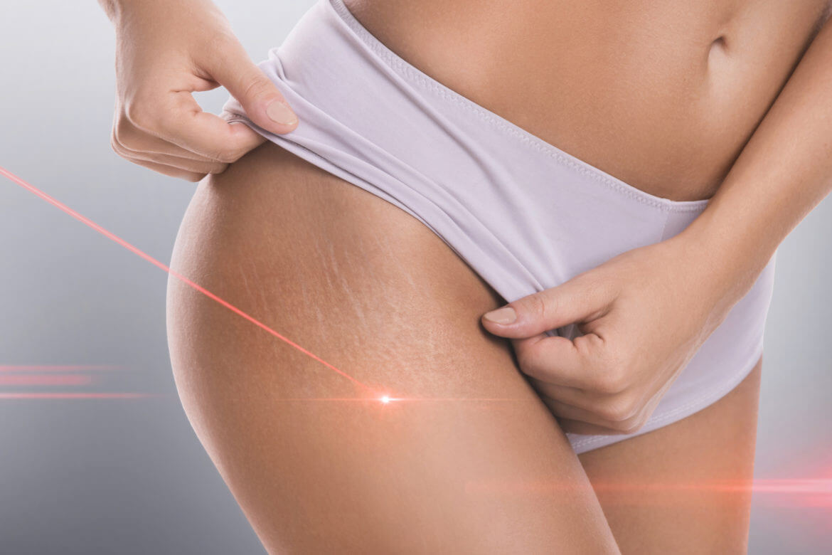 Can Cosmetic Surgery Remove Stretch Marks