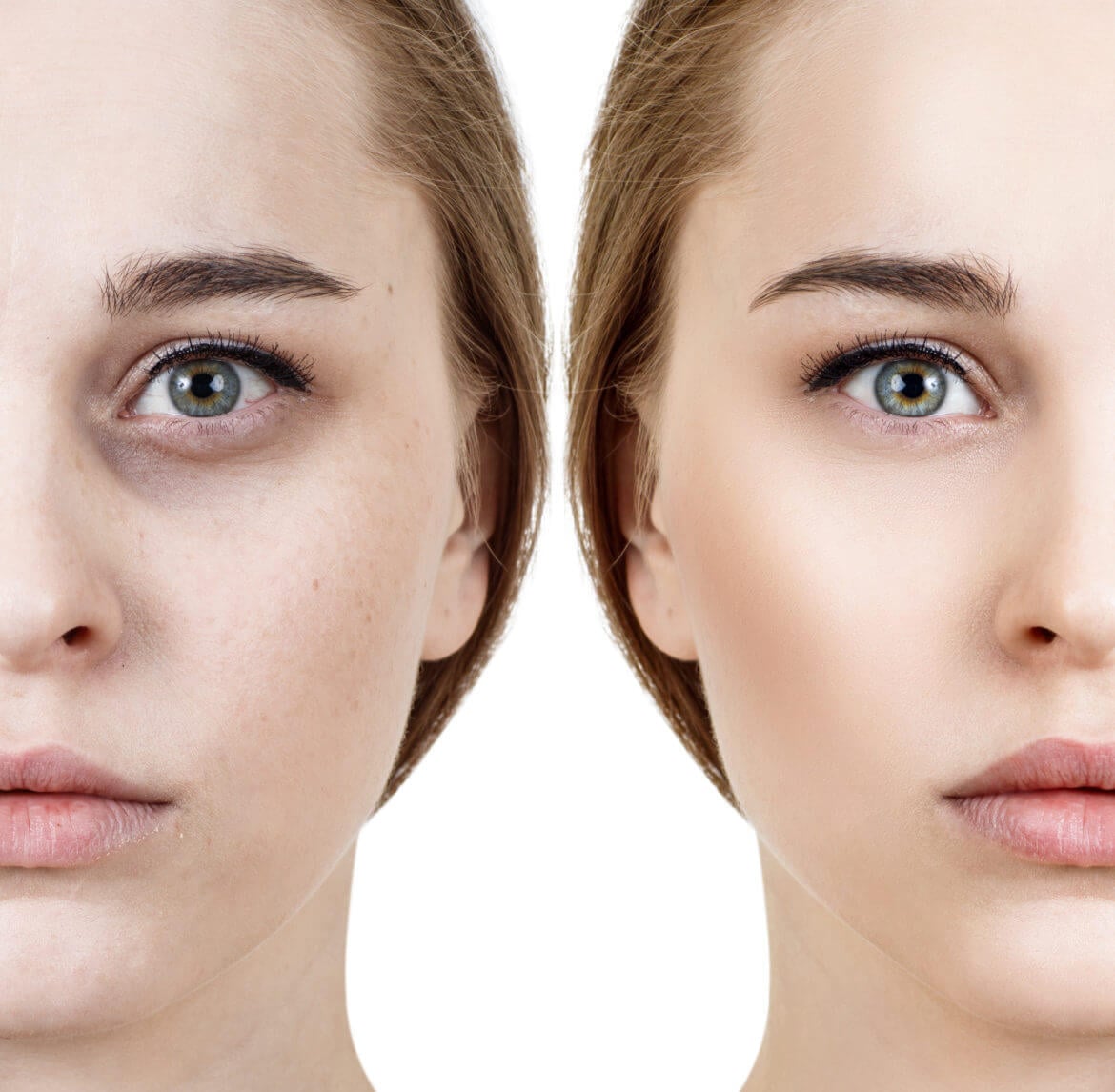Cosmetic Procedures That Remove Dark Circles and Puffy Eyes