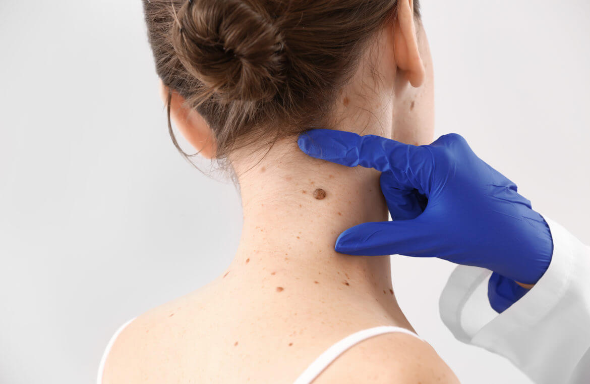 Methods for Removing Moles Safely