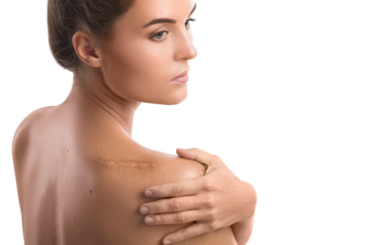 Treating Scars with Cosmetic Surgery