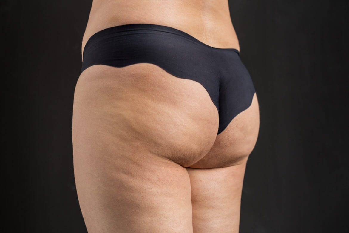 Will Liposuction Reduce Cellulite