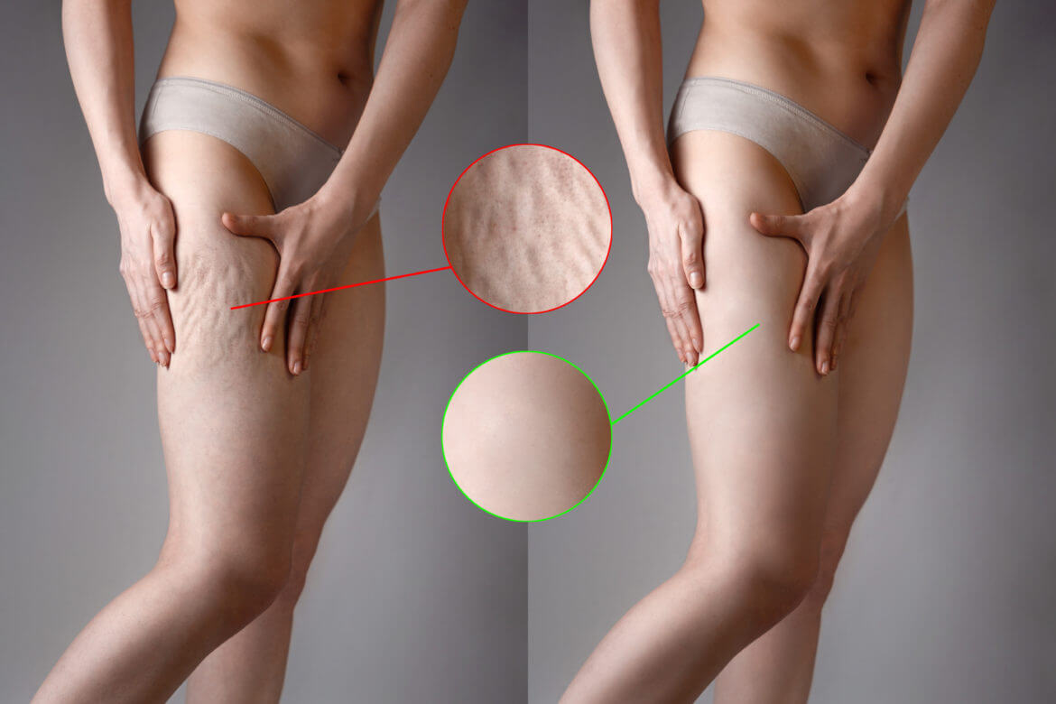 Can I Get Laser Lipo to Remove Cellulite?
