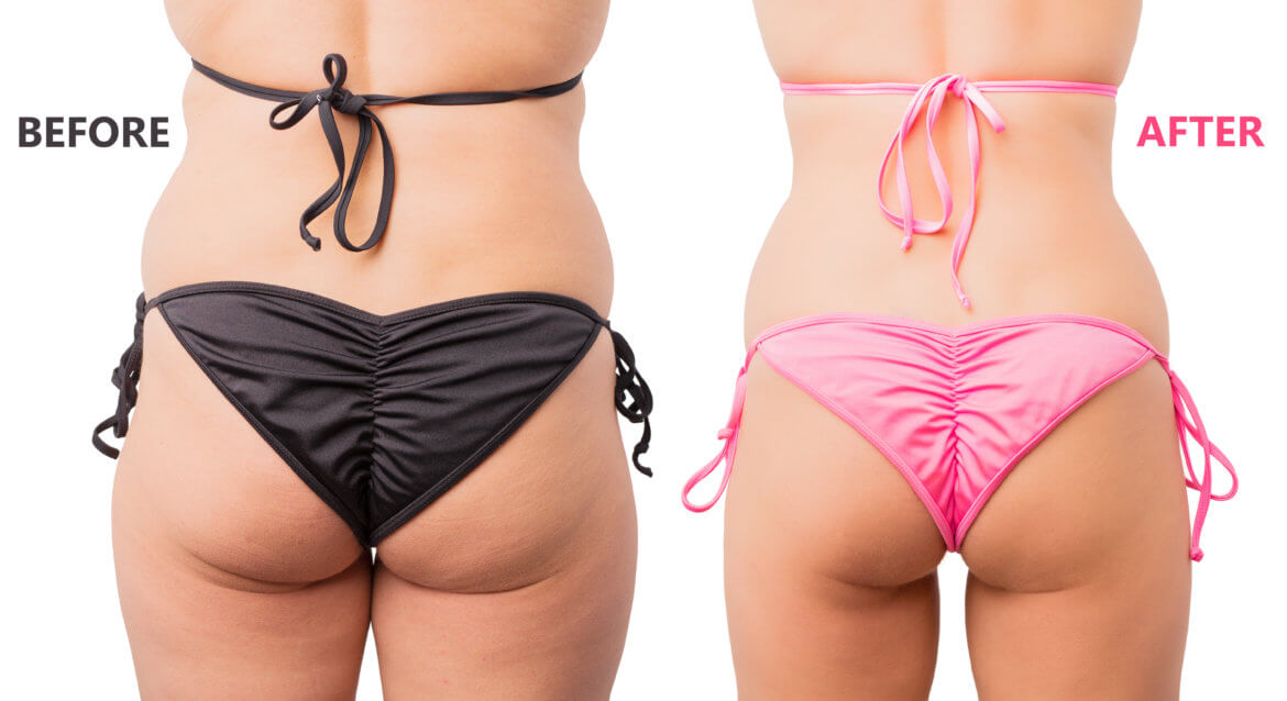 Laser Lipo Skin Tightening