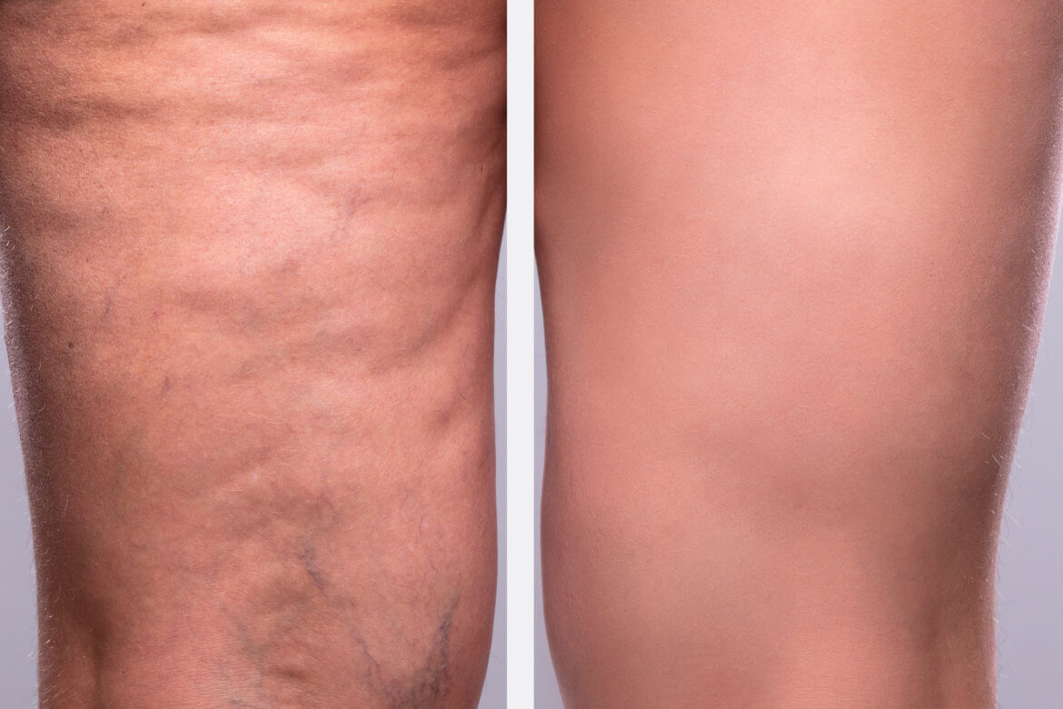Cellulite: Why it Forms, and How to Treat it