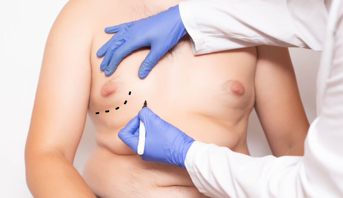 Gynecomastia How to Treat Enlarged Male Breasts