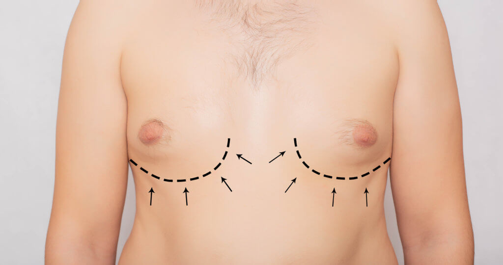 Gynecomastia How to Treat Enlarged Male Breasts