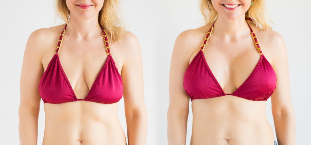 The Breast Lift: Mastopexy Costs, Safety, and Recovery