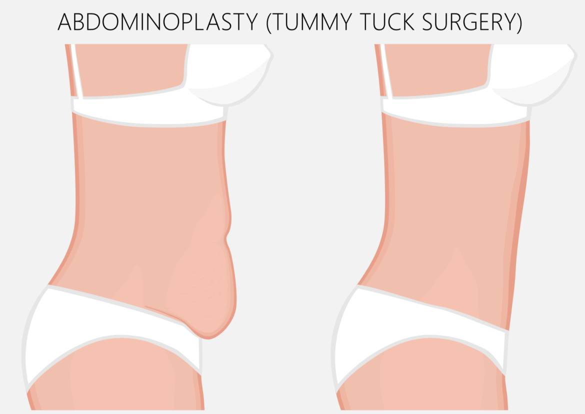 The Abdominoplasty: Tummy Tuck Prices, Candidates, Recovery, and Risks