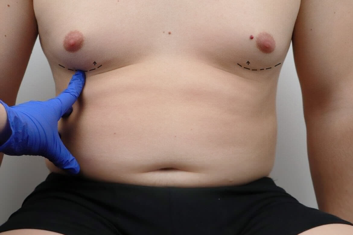 Noninvasive Body Contouring Procedures Designed For Men