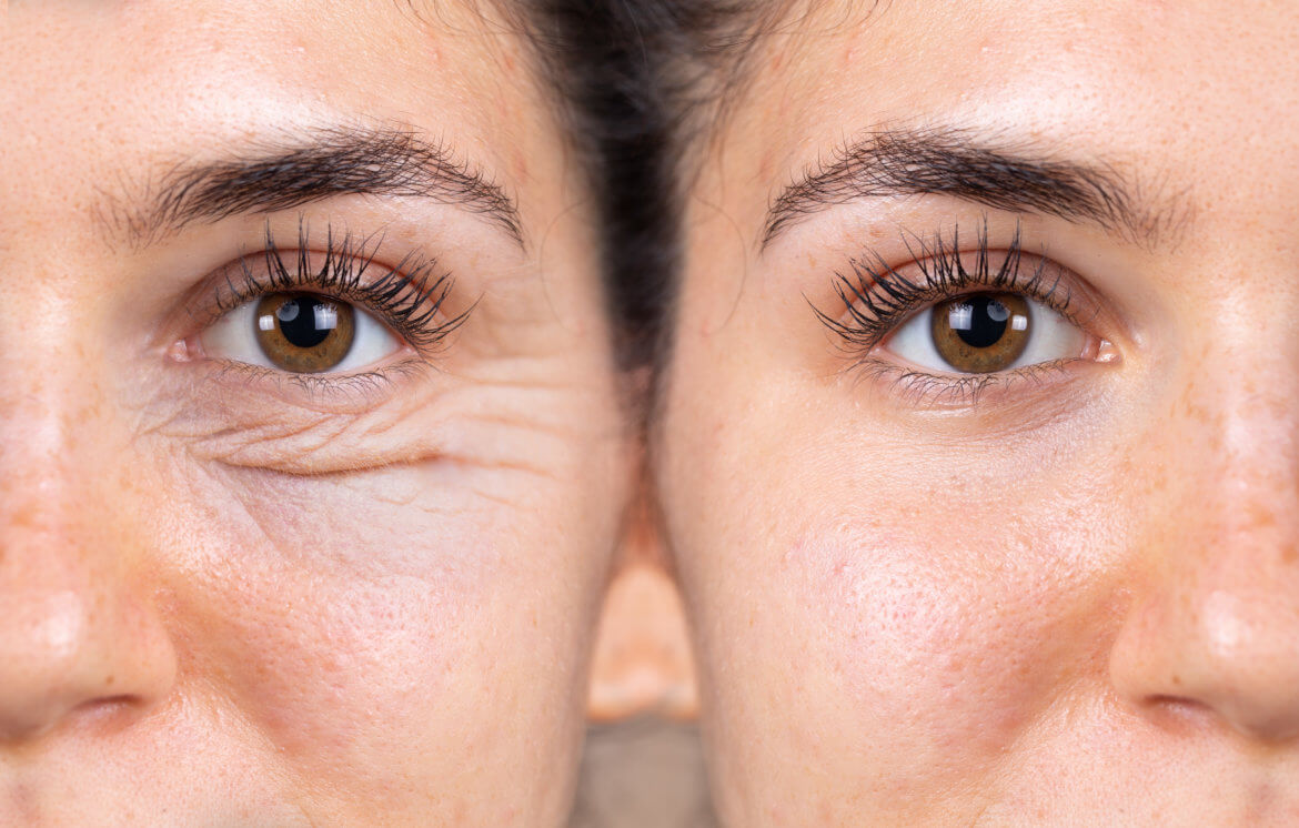 Recovering from Eyelid Surgery: Steps, Tips, and What You Can Expect After a Blepharoplasty