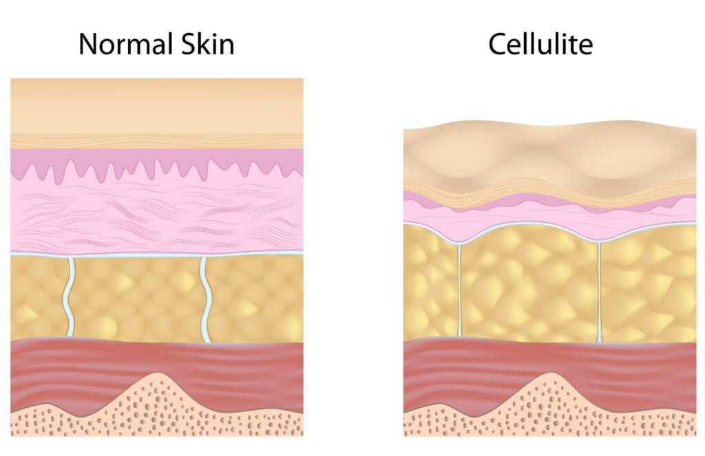 Cellulaze Prices, Recovery, Risks, and How it Treats Cellulite