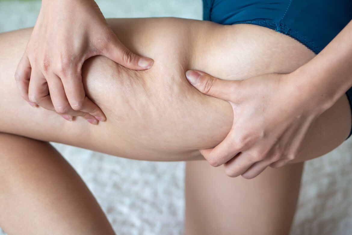 Cellulaze Prices, Recovery, Risks, and How it Treats Cellulite